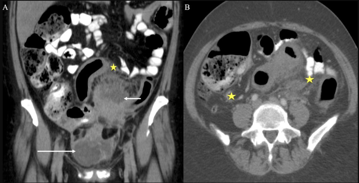 IJGConline's tweet photo. #CaseStudy
"#Infection versus #cancer: management of actinomyces mimicking #CervicalCancer or #OvarianCancer"
https://t.co/UVmWwzznCs
#GYNoncology #Education @GynMe4 @IJGCfellows @pedroramirezMD @AcadPathol @InfectDisNews @ImperialInfect https://t.co/N1sbKy9aV8
