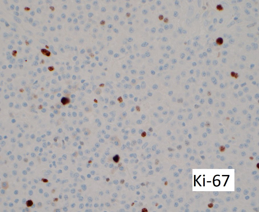 Nasal mass 70 y/o
#hemepath #pathology <a href="/et565/">Etan Marks, DO</a> #pathologyresidents