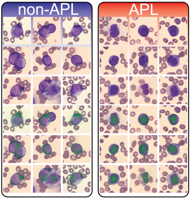 Finally, we provide "explainable AI" by incorporating an integrated gradients approach to reveal the relevant morphological features that are characteristic of APL. Surprisingly, we found our model did not identify Auer rods as being specific/sensitive for APL.