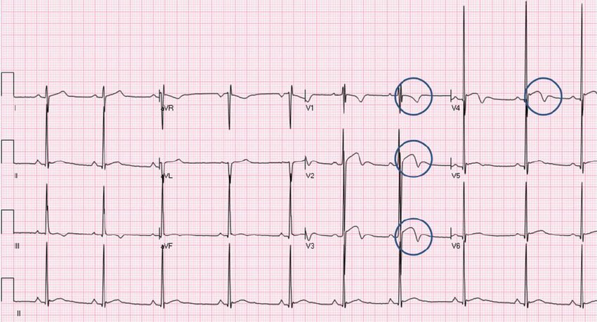 fundamentalofSM's tweet photo. Based on the international criteria for ECG interpretation in athletes: black athletes demonstrate a repolarolisation variant on ECG in Anterior leads/V1-V4 consisting of J point elevation and convex ST segment elevation followed by T wave inversion. This is normal ECG finding. https://t.co/UpcxHS2INy