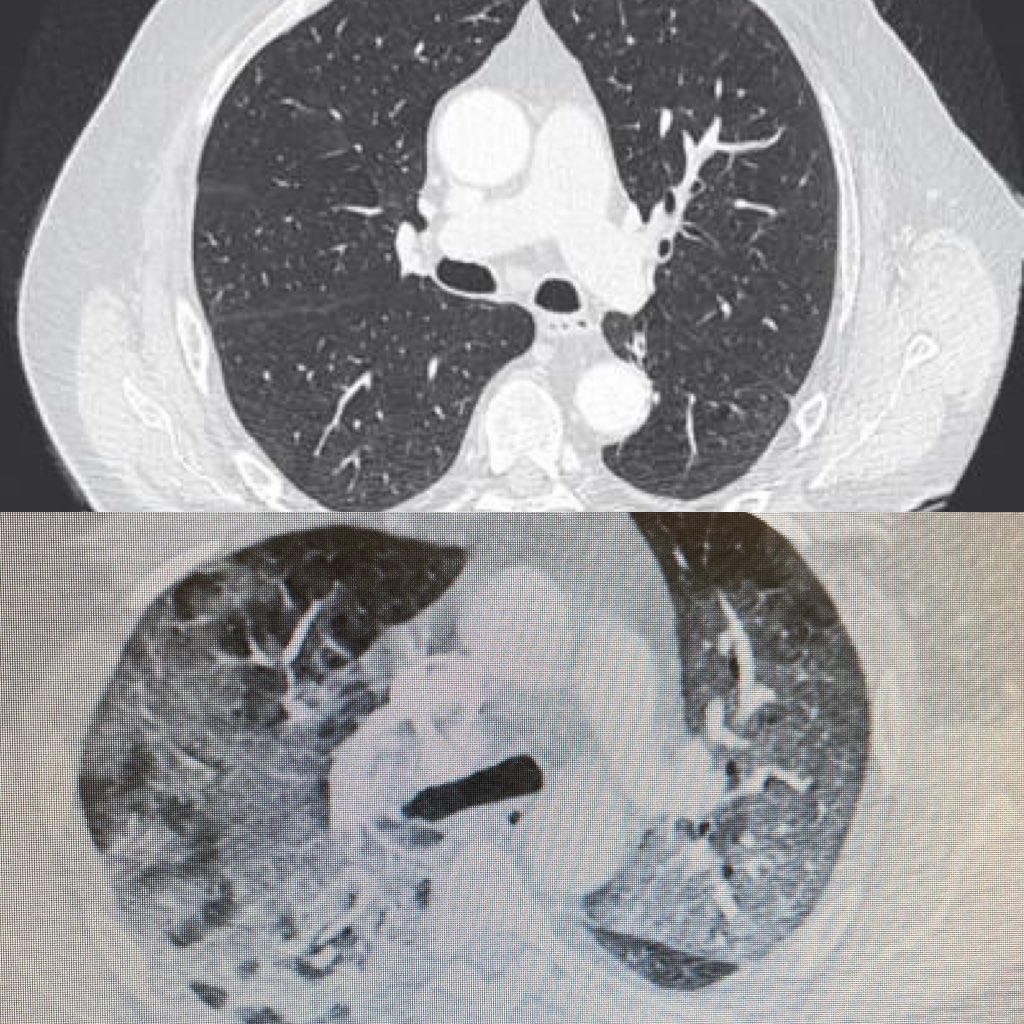 Matenolol's tweet photo. Au dessus un scanner thoracique normal. En dessous le scanner thoracique de mon patient de 49 ans atteint du covid. 
Un petit bisous sans masque aux complotistes. https://t.co/AVLAgo8KEu