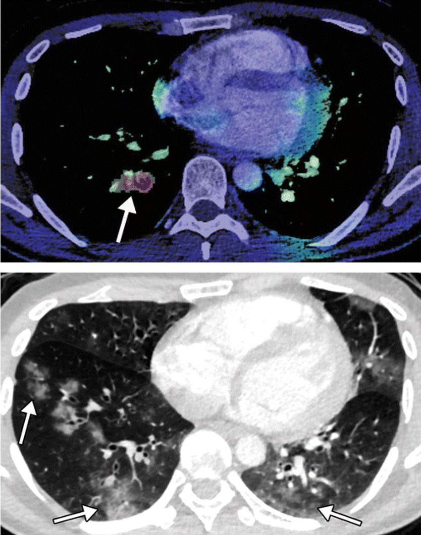 _System_X_'s tweet image. L'imagerie est essentielle dans le #diagnostic de toutes les manifestations du #COVID19 affectant le système #respiratoire et autres systèmes organiques.  L’interprétation des examens d’imagerie représente un enjeu crucial.  @RSNA 
En savoir plus ⏩ bit.ly/366TcbM