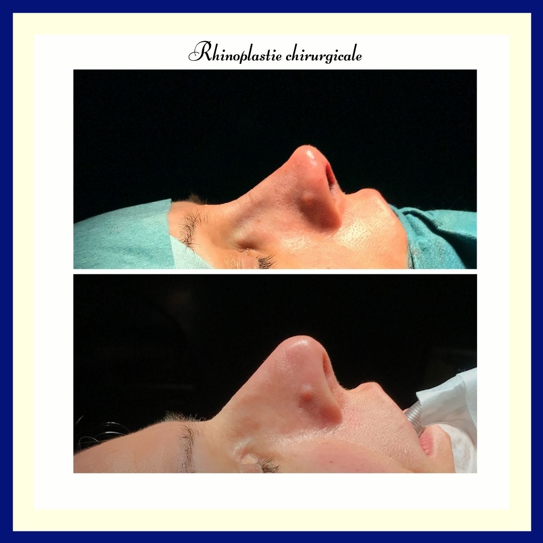 DocteurDeRunz's tweet photo. Aspect immédiat en fin d'intervention après une Rhinoplastie 👃🏻  (#Preservation)
🩺 Rhinoplastie 
#Rhinoplastie #rhinoplasty #rhinoplastyexpert #rhino #aestheticsurgery #aesthetic  #metz #lorraine #esthetique #luxembourg #nosejob https://t.co/9MYcDti0U2