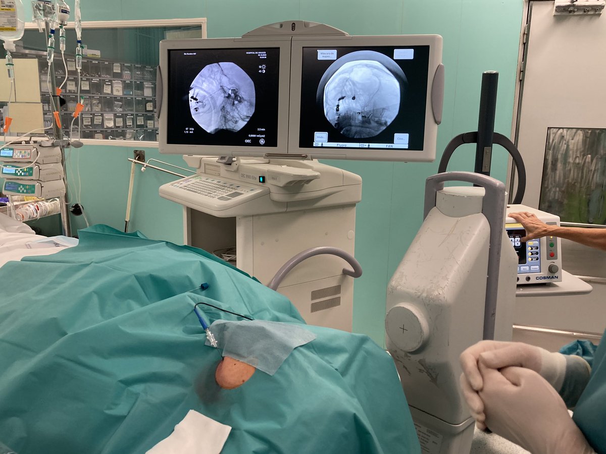 deilasuen's tweet image. Hoy nos dedicamos al dolor facial #Neuralgiadeltrigemino#Radiofrecuencia ganglio Gasser #dolorfacial