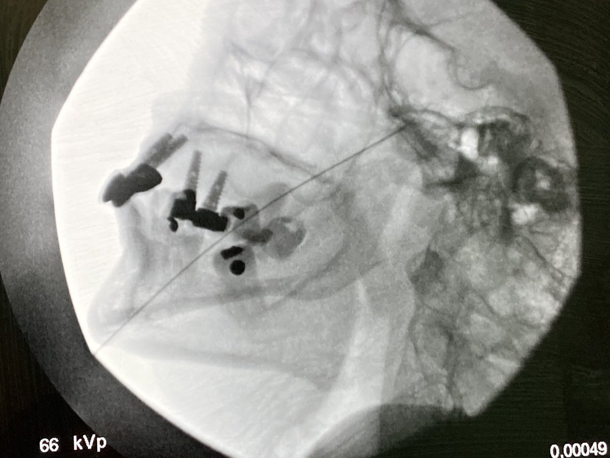 deilasuen's tweet image. Hoy nos dedicamos al dolor facial #Neuralgiadeltrigemino#Radiofrecuencia ganglio Gasser #dolorfacial