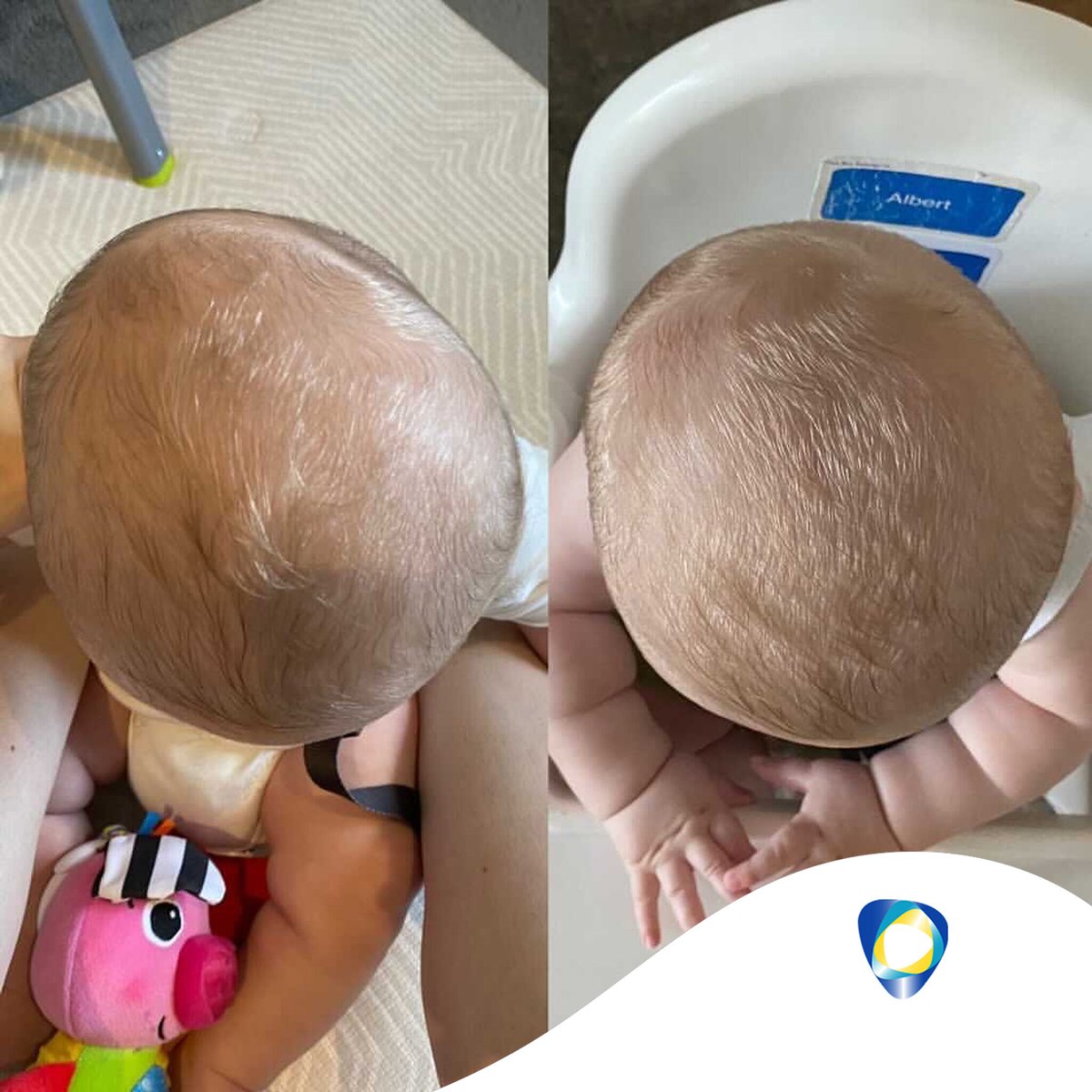 technoinmotion's tweet photo. Hugo's Mum, Alexandra recently got in contact with Technology in Motion and shared these photos of Hugo as Alexandra mentioned that he has taken in the new treatment very well.

#technologyinmotion #timbandair #flatheadsyndrome https://t.co/HITkbSx8s4