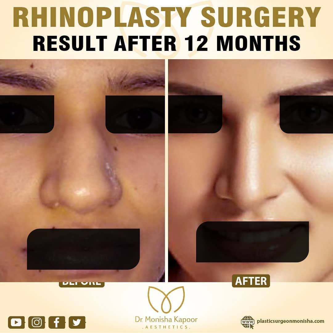 aestheticsdelhi's tweet photo. Rhinoplasty is a surgery that combines science and art to deliver a perfect shape that suits a person’s face.
#rhinoplastygallery #rhinoplastysurgery #nosehumpreduction #bestrhinoplasty #nosebridge #noseconstruction #noseshapping #reducenosehump https://t.co/SNBRLdcw2m