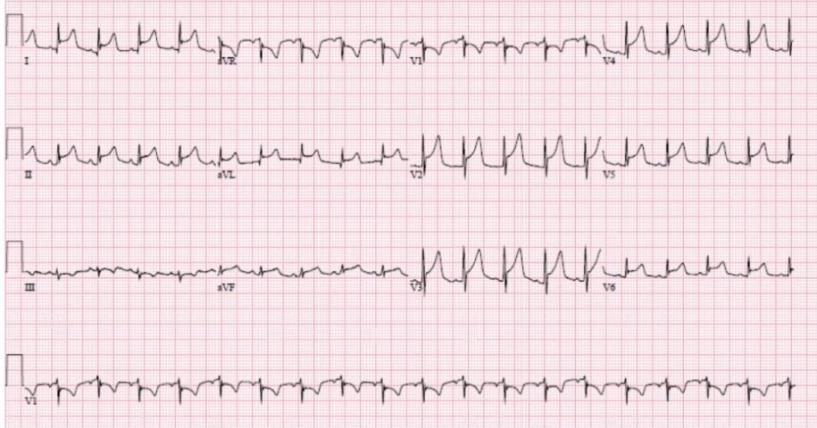 Dr_DanMD's tweet photo. Chest pain with this classic #ECG https://t.co/lsvhO0qvyF