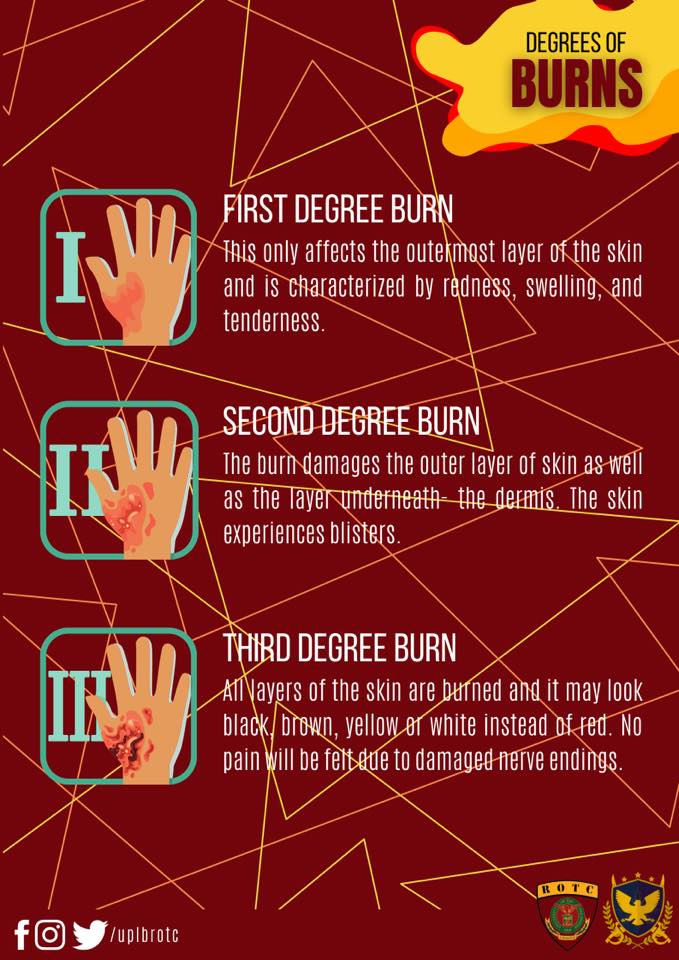 uplbrotc's tweet photo. A burn is a tissue damage which can be caused by heat, chemical, electricity, and hot liquid or steam. 

(1/4)
#RAM2020 
#UPLBROTCTheBest https://t.co/9FP9JMcVPu