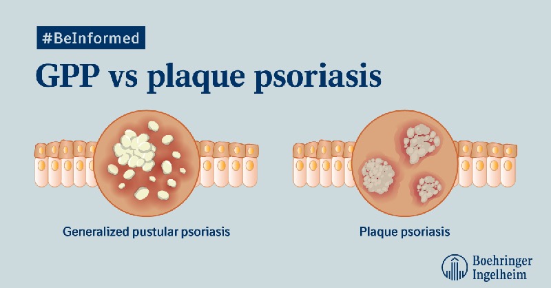 Generalised Pustular Psoriasis
