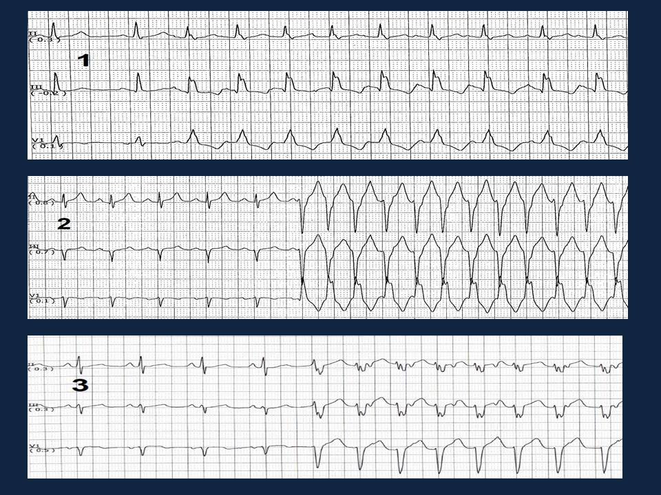 Pragmatic slide  #tweetorial on Wide Complex Tachycardia (WCT) with emphasis on Cardiac Telemetry. Part 2 - The initiation Pattern #FOAMed  #Meded  #Epeeps  #CardioTwitter  #MedStudentsTwitter