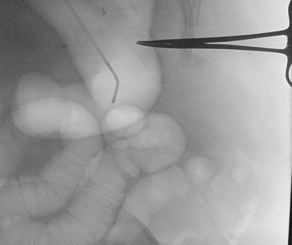 NshRadiology's tweet photo. Under #GA. Done in #OR using #C_arm. This #PercutaneousGastrostomy was done in collaboration with our #Otolaryngology team for #Tracheostomy Insertion & #MaxillofacialSurgery Team for mandibular mass biopsy 2 save this ASA IV patient from the risk of multiple GA sessions. #Hybrid https://t.co/4vwgFd5Y0Y