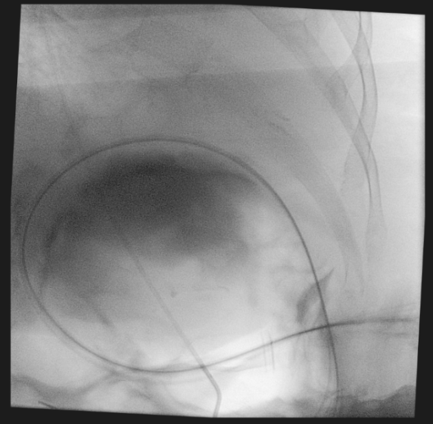 NshRadiology's tweet photo. Under #GA. Done in #OR using #C_arm. This #PercutaneousGastrostomy was done in collaboration with our #Otolaryngology team for #Tracheostomy Insertion & #MaxillofacialSurgery Team for mandibular mass biopsy 2 save this ASA IV patient from the risk of multiple GA sessions. #Hybrid https://t.co/4vwgFd5Y0Y