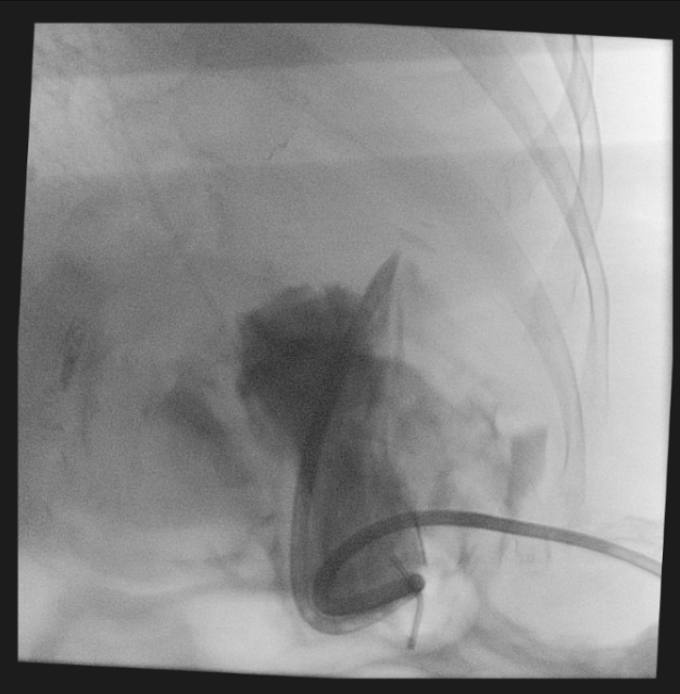 NshRadiology's tweet photo. Under #GA. Done in #OR using #C_arm. This #PercutaneousGastrostomy was done in collaboration with our #Otolaryngology team for #Tracheostomy Insertion & #MaxillofacialSurgery Team for mandibular mass biopsy 2 save this ASA IV patient from the risk of multiple GA sessions. #Hybrid https://t.co/4vwgFd5Y0Y