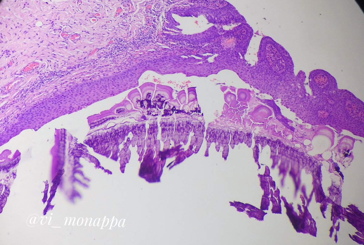 Lip bx. #pathology #oralpath
Pretty looking....