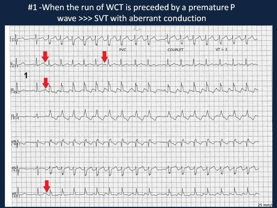 Pragmatic slide  #tweetorial on Wide Complex Tachycardia (WCT) with emphasis on Cardiac Telemetry. Part 2 - The initiation Pattern #FOAMed  #Meded  #Epeeps  #CardioTwitter  #MedStudentsTwitter