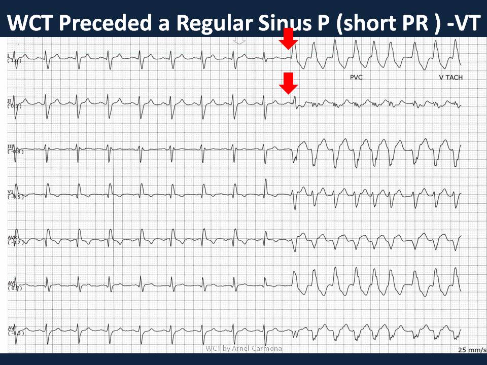 Pragmatic slide  #tweetorial on Wide Complex Tachycardia (WCT) with emphasis on Cardiac Telemetry. Part 2 - The initiation Pattern #FOAMed  #Meded  #Epeeps  #CardioTwitter  #MedStudentsTwitter