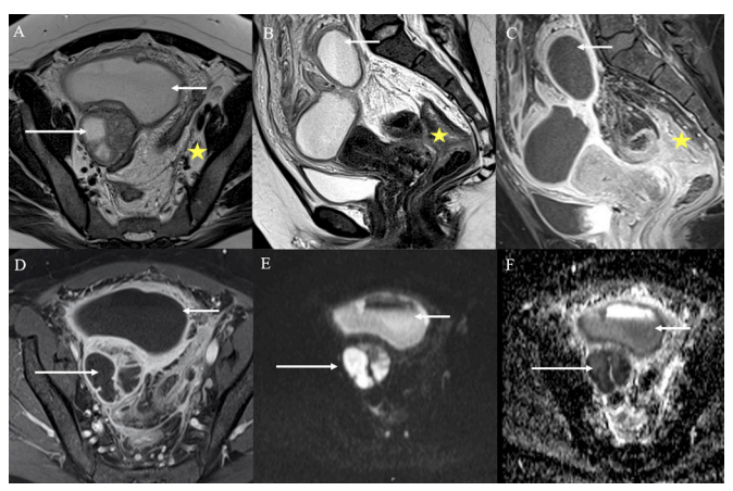 IJGCfellows's tweet photo. #cancer 🆚 #infection
Based on these imaging findings... what is the differential diagnosis for this patient?
#challenge #ovariancancer #mimicks #actinomyces @OncoAlert @IJGConline @ESGO_society @c_saezperrota
Check this #diagnostics #challenge
👇👀
https://t.co/MwAuI4JU2P https://t.co/B28OAjMGKh