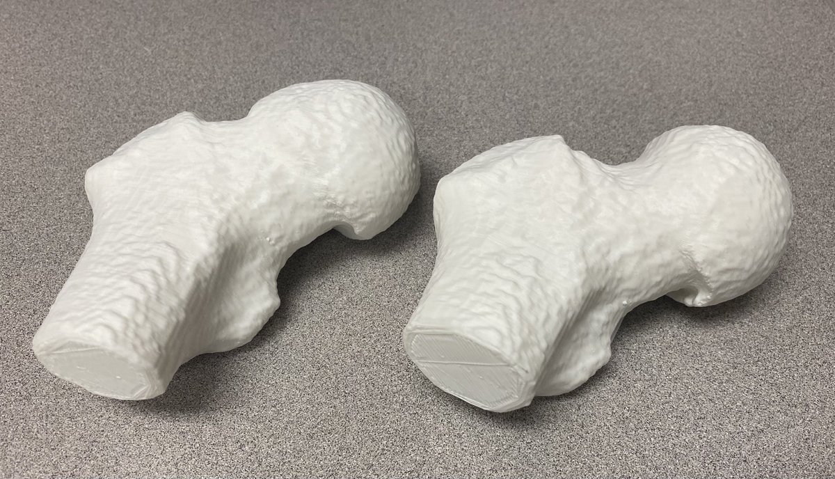 winstongwathmey's tweet photo. My star MS4 Dan Lewis 3D printed a proximal femur CT before and after femoroplasty.  Cool way to understand the power of a good correction. https://t.co/qpebwbV0tl