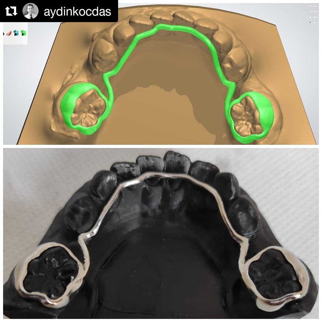 #intraoralscanner ile klinik ve #dijitalölçü olarak dijitalize olan hekimlerimiz, sonrasında dijital ortodontik lab çözümler ile hastalarına sundukları hizmetlerde de çıtayı  yükseltiyor.👏#Dijital #Digitalorthodontics #lingualarch #dijitalortodonti #digitaldentistry #lingualark