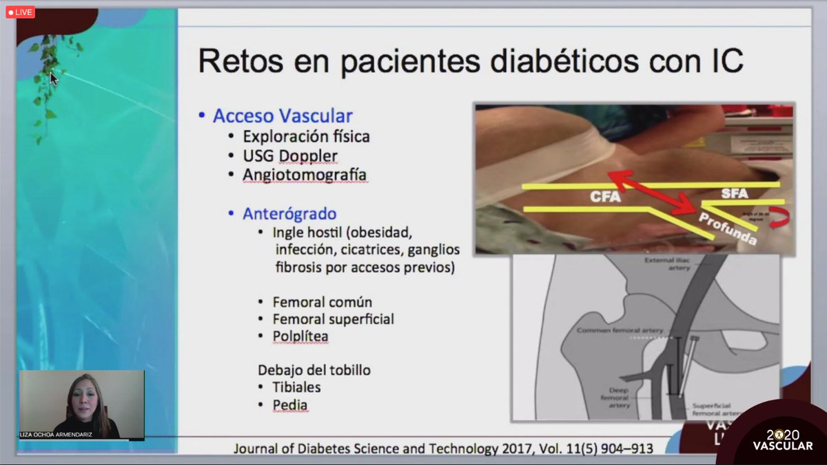 smacve_oficial's tweet photo. 📍LII Congreso Internacional de Angiología, Cirugía Vascular y Endovascular #Merida2020
SESIÓN AMEXIPIED "Pie diabético e Isquemia: la combinación del Desastre"
“Estado actual de la cirugía endovascular en el manejo del pie diabético isquemícol”
Dra. Liza Ochoa Armendariz https://t.co/NoqeVwCWjh