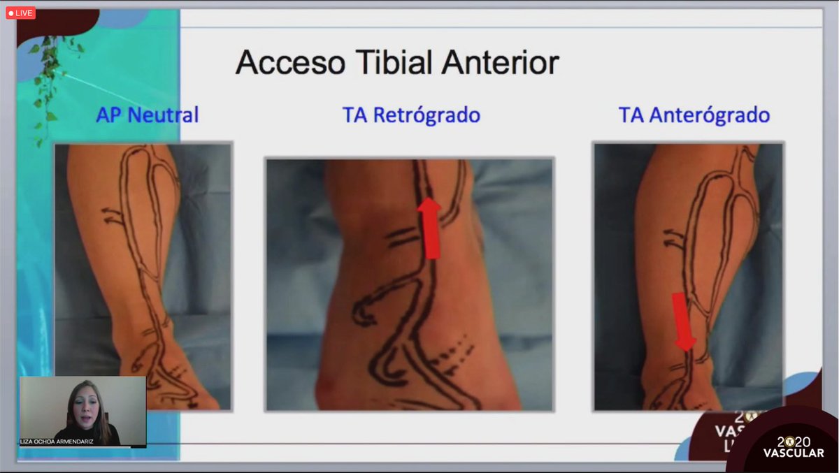 smacve_oficial's tweet photo. 📍LII Congreso Internacional de Angiología, Cirugía Vascular y Endovascular #Merida2020
SESIÓN AMEXIPIED "Pie diabético e Isquemia: la combinación del Desastre"
“Estado actual de la cirugía endovascular en el manejo del pie diabético isquemícol”
Dra. Liza Ochoa Armendariz https://t.co/NoqeVwCWjh