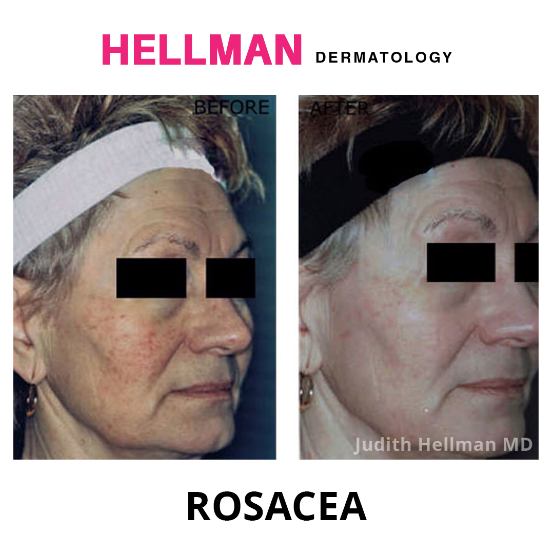 Dr. Judith Hellman uses the latest in cosmetic laser technology to reduce the appearance of rosacea in her patients.