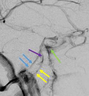 eytanraz's tweet photo. Great #SkullBase venous anatomy 🧠🍌 #IPS (inferior petrosal sinus) can be differentiated from #IPCV (inferior petroclival vein) on any angiogram. https://t.co/OGGQFh8kFe