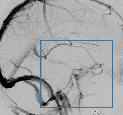eytanraz's tweet photo. Great #SkullBase venous anatomy 🧠🍌 #IPS (inferior petrosal sinus) can be differentiated from #IPCV (inferior petroclival vein) on any angiogram. https://t.co/OGGQFh8kFe