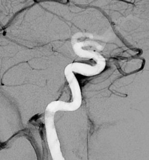 eytanraz's tweet photo. Great #SkullBase venous anatomy 🧠🍌 #IPS (inferior petrosal sinus) can be differentiated from #IPCV (inferior petroclival vein) on any angiogram. https://t.co/OGGQFh8kFe