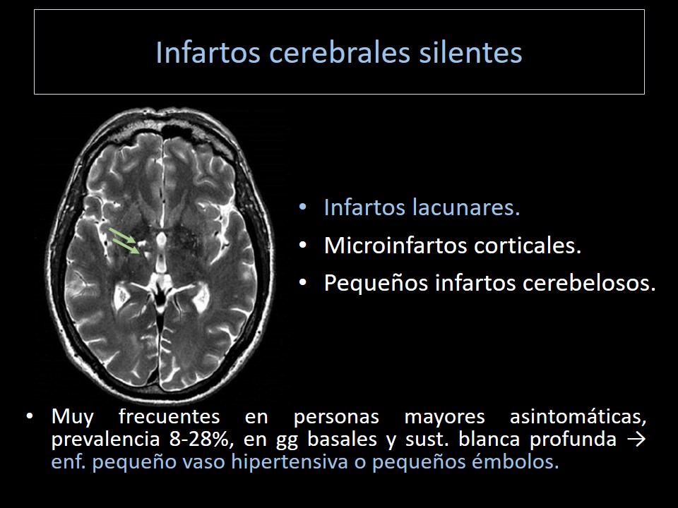serammeA6SALUD's tweet photo. Magnífica sesión monográfica nuestro Carlos Vázquez @serammeA6SALUD sobre el envejecimiento normal y anomal del cerebro, con un repaso de los conceptos básicos para @residentesSERAM y radiólogos no neurorradiólogos. También útil para estudiantes @damedium. #RadiologíaPensandoEnTi https://t.co/VrF33pqDjR