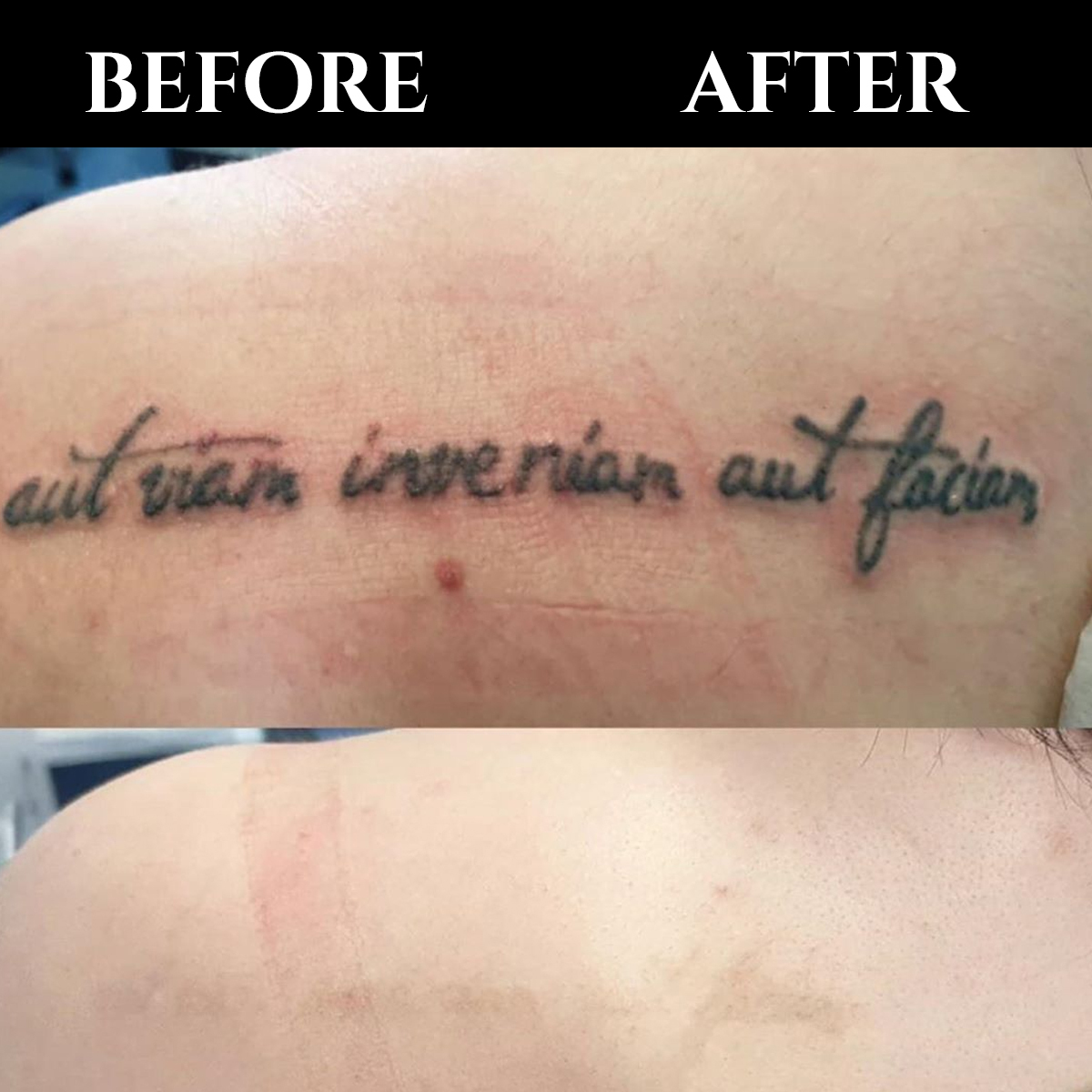 💫Do you have tattoos you no longer happy with? we can remove them with our enlighten Pico laser. Credits: cutera.anz #tattooremoval #RhodeIsland
