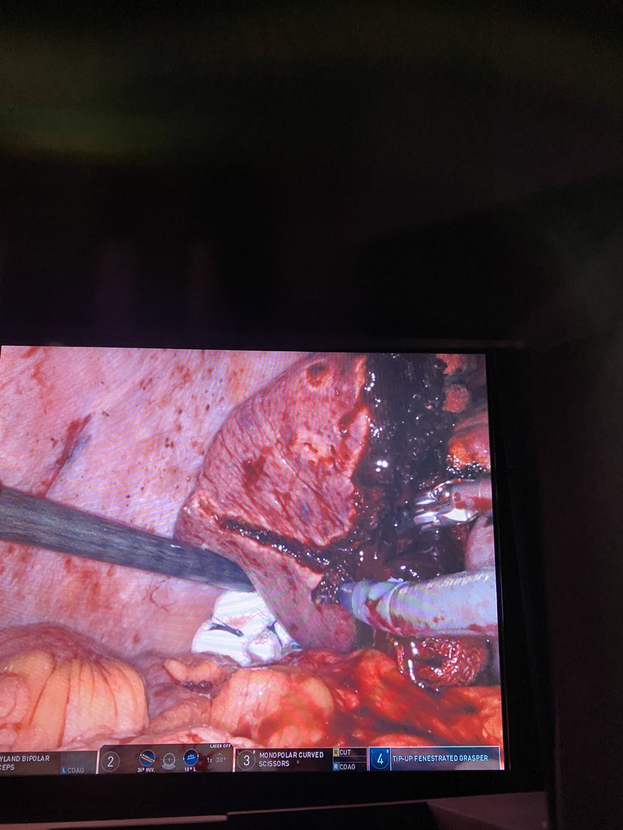Cirugía HBP y Gástrica H. Arnau de Vilanova Lérida (@hbp_eglleida) on Twitter photo Resección atípica sVI hepático mediante #DaVinciXi por M1 en paciente con antecedente de RAB por ADK rectal #hbpsurgery @seccionhbpaec <a href="/SeclaEndosurg/">SECLA</a> <a href="/aecirujanos/">aecirujanos</a> <a href="/harnaulleida/">Hospital Universitari Arnau de Vilanova</a> <a href="/santiazagra/">Juan Santiago Azagra</a> <a href="/HpbMar/">HPB unit Hospital del Mar</a> <a href="/abexDaVinci/">ABEX Excelencia Robótica</a> <a href="/hpb_so/">SoMe4HPB</a> Resección atípica sVI hepático mediante #DaVinciXi por M1 en paciente con antecedente de RAB por ADK rectal #hbpsurgery @seccionhbpaec <a href="/SeclaEndosurg/">SECLA</a> <a href="/aecirujanos/">aecirujanos</a> <a href="/harnaulleida/">Hospital Universitari Arnau de Vilanova</a> <a href="/santiazagra/">Juan Santiago Azagra</a> <a href="/HpbMar/">HPB unit Hospital del Mar</a> <a href="/abexDaVinci/">ABEX Excelencia Robótica</a> <a href="/hpb_so/">SoMe4HPB</a>
