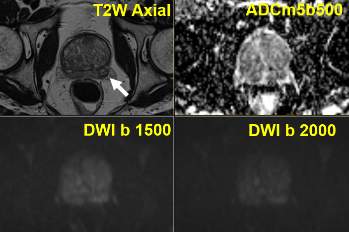 jambor_ivan's tweet photo. 1/2 #prostateMRIcases #case16 #MultiIMPROD2 #IMPRODbpMRI at 1.5T Extruded BPH nodule in PZ https://t.co/SQG1aLtaqX