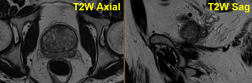 jambor_ivan's tweet photo. 1/2 #prostateMRIcases #case16 #MultiIMPROD2 #IMPRODbpMRI at 1.5T Extruded BPH nodule in PZ https://t.co/SQG1aLtaqX