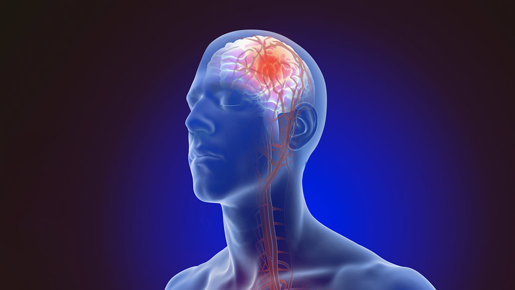 VigyaR's tweet photo. Symptoms of stroke include trouble walking, speaking and understanding, as well as paralysis or numbness of the face, arm or leg.
Consult the experts @DrPNRenjen @dr_dinesh_c
All About Stroke
#Allaboutstroke @HealthwireMedia https://t.co/7i1TtbCCpa