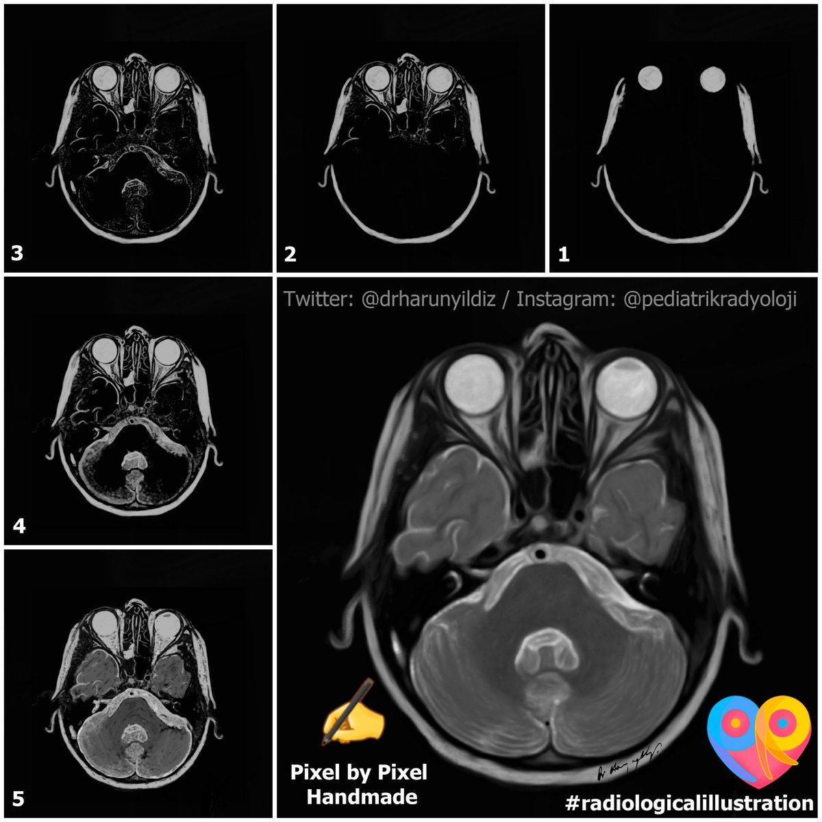 Radiogenomics of Medulloblastoma -1 

🔶️Group 3 - Molecular Subgroup 

Watch out! This image isn't a real MR image! ✍ 

#radiologicalillustration
#pedineurorad #neurad #medicalillustration #radiology #pediatrikradyoloji #neurology #neurosurgery #neuroscience #pedrad #meded