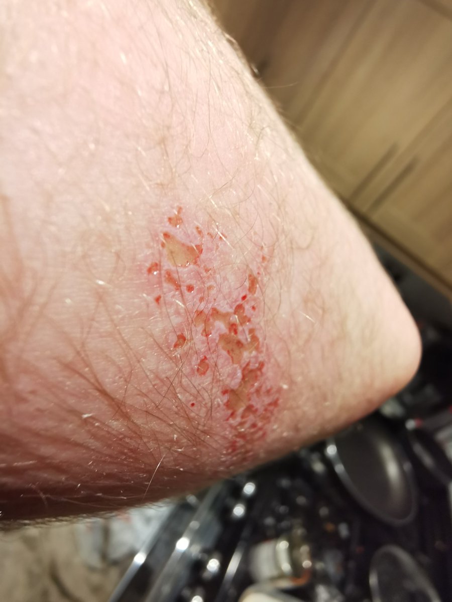 TheTeddeRz's tweet photo. @Dexelele There could be worse burns to have, try lime as it eats into your skin https://t.co/sdZE7LjuP3