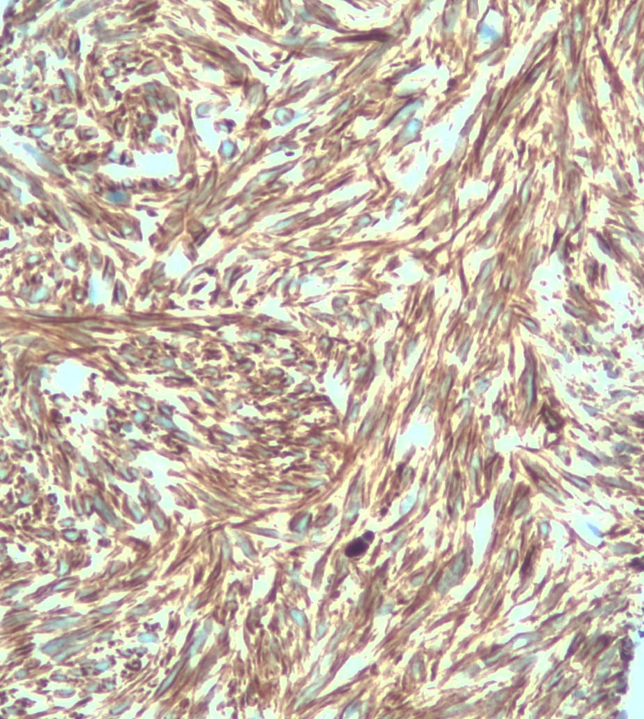 mdlozanoe's tweet photo. FNA of a mass in pancreas tail. Spindle cell bundles with blunt-edged nuclei. SMA and Desmin + in cellblock. The patient has a history of leiomyosarcoma of vena cava #Cytopath #Pathresidents https://t.co/VbLmhx2Vfa