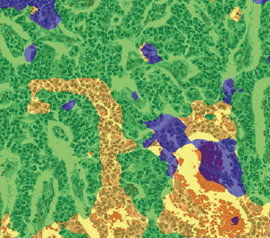 futurepathology's tweet photo. #AI will augment pathology! #DeepLearning  may assist pathologists with site of origin in neuroendocrine tumors.  Proud of my colleagues @UNMPathology including @JHansonPathMD 
https://t.co/Fwe54UeI97 https://t.co/gtzxWRRIxt