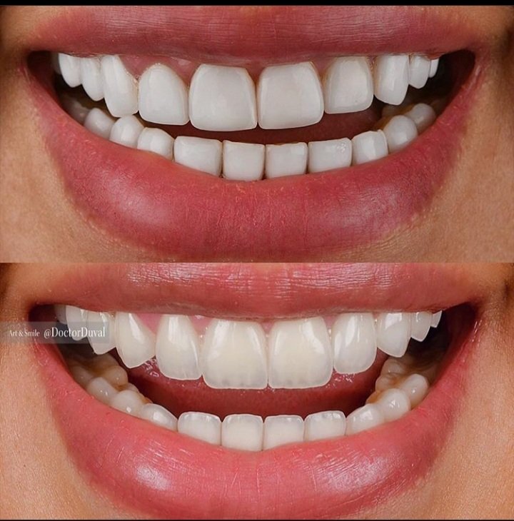 Ini antara contoh estetik pergigian yang hebat. Perhatikansimetri - gigi kanan ibarat cerminan gigi kiribentuk gigi yang unik utk tiap2 batang gigi - bentuk satu2 gigi tak sama dgn gigi bawah/sebelahwarna gigi berbeza di pangkal & di hujung gigi - bukan solid mcm mentos