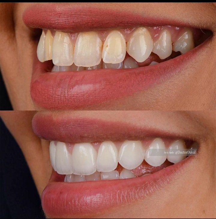 Ini antara contoh estetik pergigian yang hebat. Perhatikansimetri - gigi kanan ibarat cerminan gigi kiribentuk gigi yang unik utk tiap2 batang gigi - bentuk satu2 gigi tak sama dgn gigi bawah/sebelahwarna gigi berbeza di pangkal & di hujung gigi - bukan solid mcm mentos
