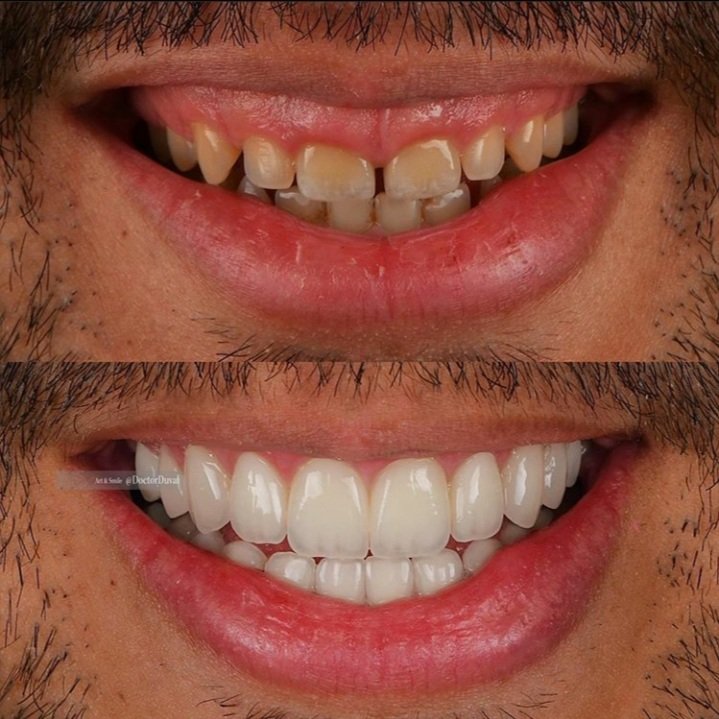 Sebenarnya estetik pergigian ni lagi dalam daripada sekadar veneer. Ada yang melibatkan terapi laser, pembedahan gusi dan pembedahan bibir. Tapi tu lain kali aku kongsi lagi. Sementara tu, berhenti daripada beri sokongan kepada fake veneers.