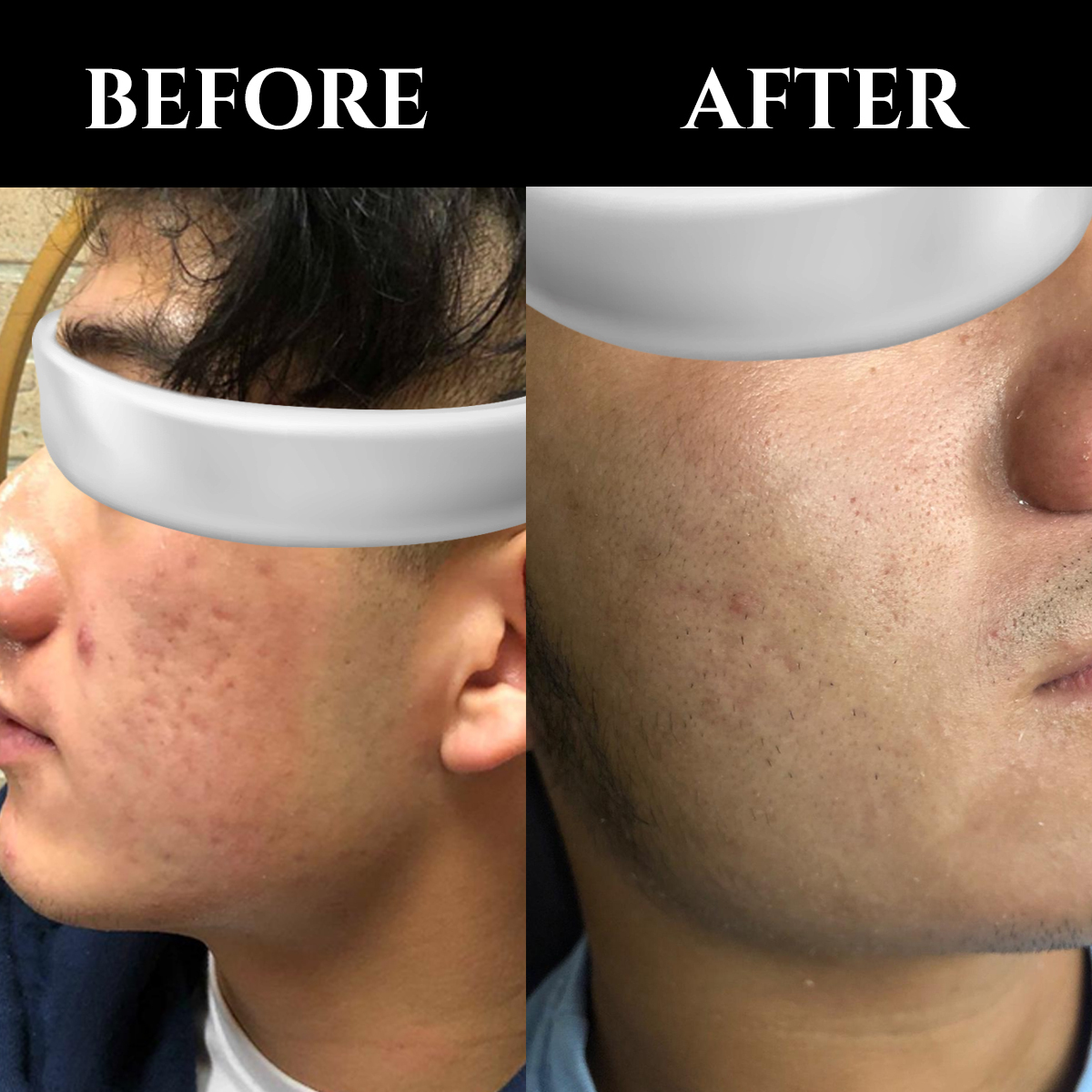 💫After 2 treatments of Secret RF Both men and women make excellent candidates for the Secret RF procedure. The secret RF treats a wide range of skin concerns and is appropriate for all skin types and has adjustable depth ability for both thick and thinner skin. #AALI