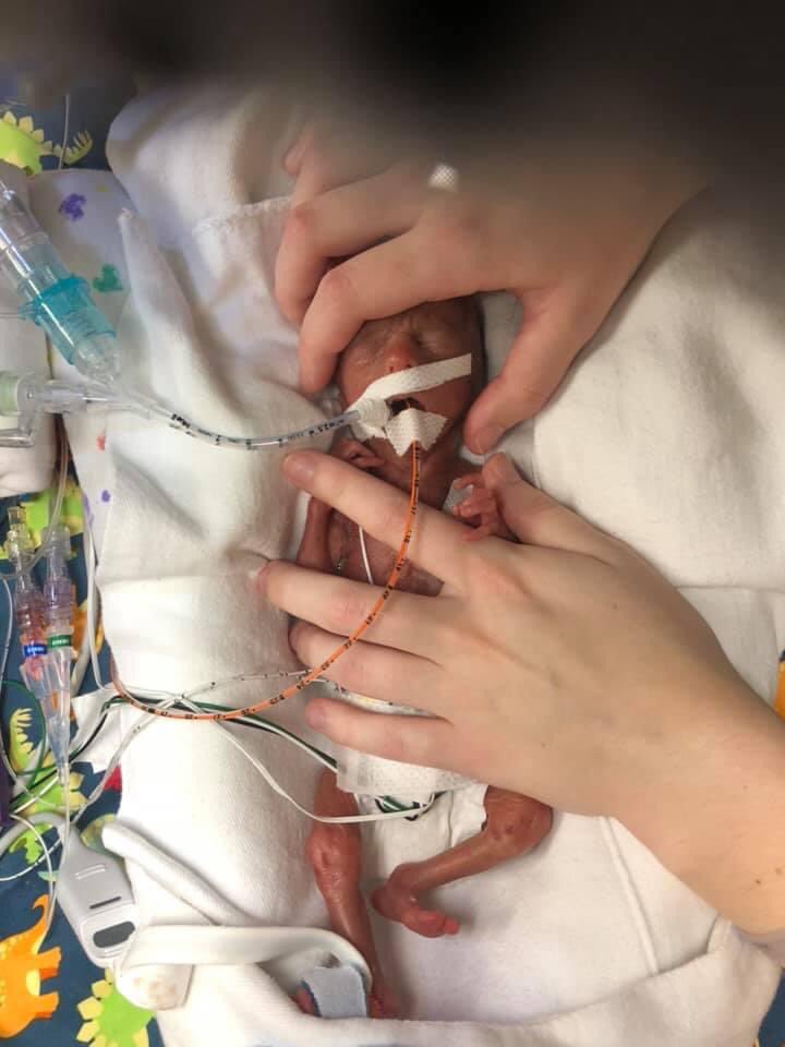22Matters's tweet photo. Born at 22 weeks 3 days at 11:47pm weighing 510g (1lb 2oz) & 11 1/2 inches long.
Lucas Eugene Ross turns 2 years old today!
143 days in NICU
Months in & out of the hospital
Oxygen still at night
feeding tube
& 1 very spontaneous & happy little guy
Striving & THRIVING! 💚💪🏻 https://t.co/KlIoJ9d27H