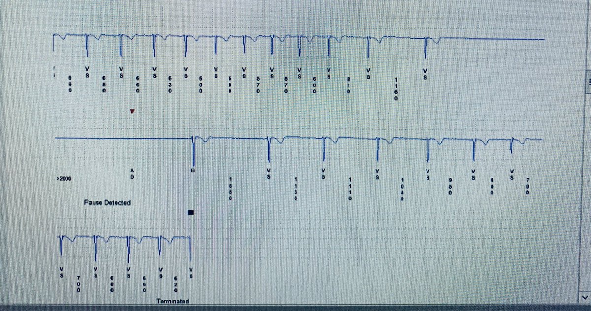 JRWinterfield's tweet image. How would you manage college aged  active woman referred to us @MUSCCardFellows with malignant vasovagal syncope with two serious episodes in two years and numerous pauses on ILR below?