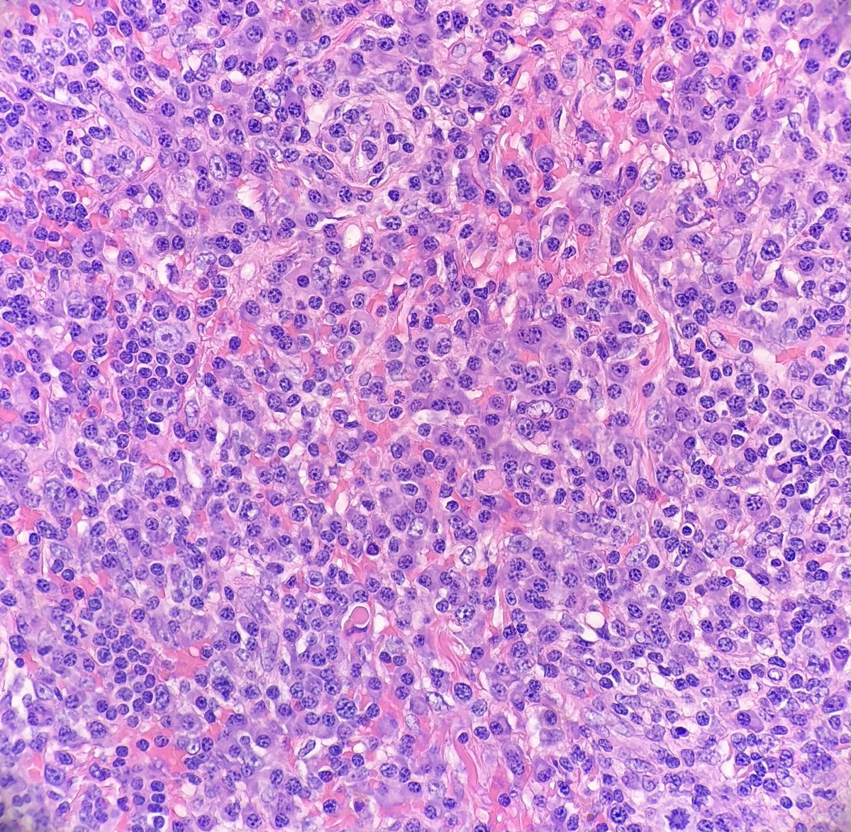 redsnapperpath's tweet photo. WOW. Large fungating neck mass, 27 YOM #dermtwitter #dermatology #dermpath 🐍 🐍 @DrGeeONE @ChristineJKoMD @Dermpathl @HENRYY_MD https://t.co/VpgrFgBH9W