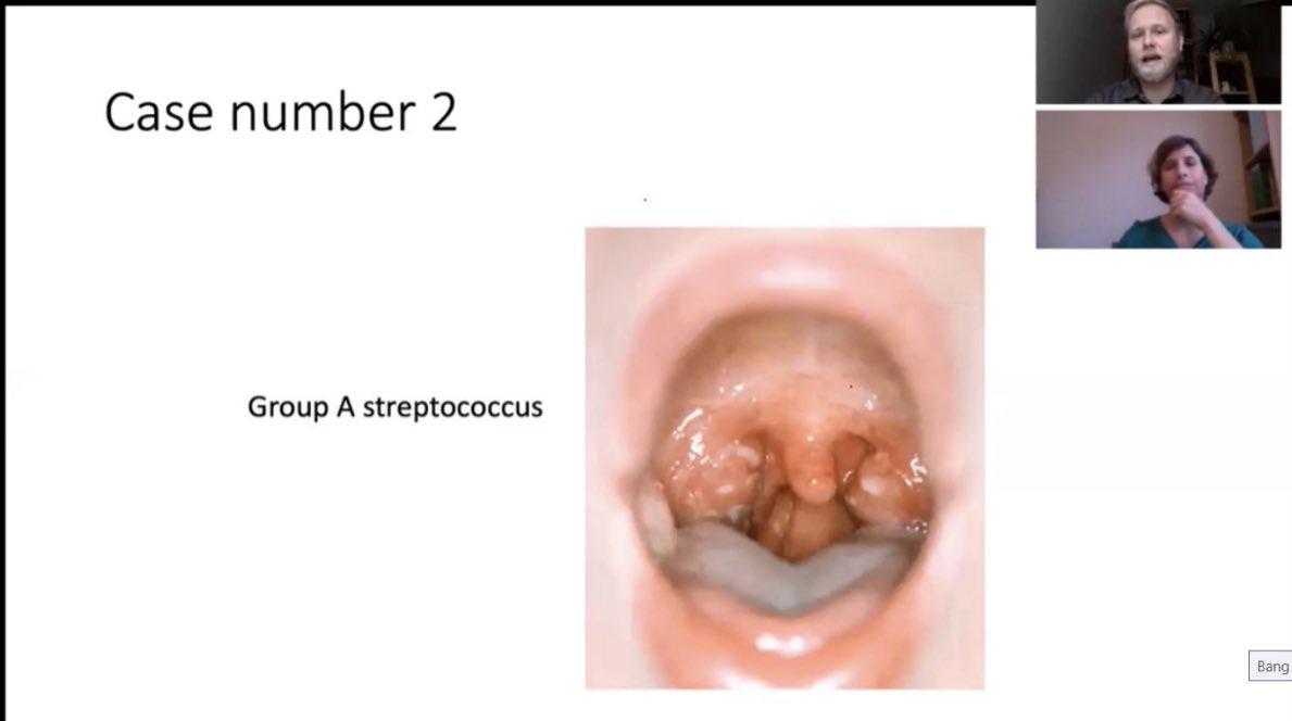 Niluni1's tweet photo. Sore throat is infection of interest in my thesis research. Thank you for interesting debate on #antibiotics to treat #sore throat  Dr.  @BorbalaZ and Dr. @LauriIvaska .!  👏👏 enjoyed a lot. @ESPIDsociety #ESPID2020  #ESPIDanywhere #from 🇨🇦 #myfirstvconferece https://t.co/uCYGbSu2zi