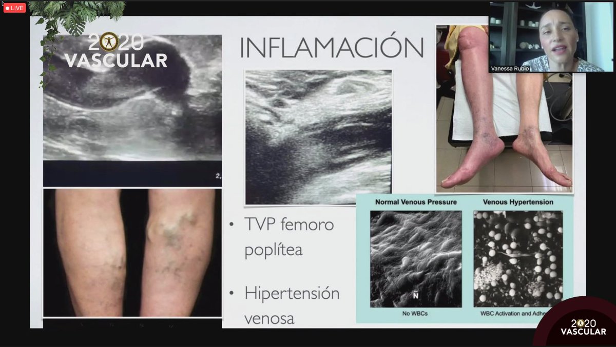 smacve_oficial's tweet photo. 📍LII Congreso Internacional de Angiología, Cirugía Vascular y Endovascular #Merida2020
CONFERENCIA MAGISTRAL SERVIER
“La inflamación, el origen de la enfermedad venosa”
Dr. Gerardo Peón Peralta
Dr. Ignacio Escotto Sánchez https://t.co/jtiVH9sWY4
