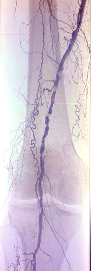 erikstilp's tweet photo. R5 CLI. Toe Pressure 0. Recent endocarditis required pacer removal.  Needs reimplant for Type2 block but not w open wound. GFR 42. Plan?  @CLIFighters @CarlosMenaYale @SJcardio @kmadass @SriniTummala @DrPatGeraghty @AllaqabanSuhail https://t.co/4hhqfwrLwD